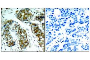 Immunohistochemical analysis of paraffin-embedded human breast carcinoma tissue, using cdc25A (phospho-Ser75) antibody (E011138). (CDC25A antibody  (pSer75))