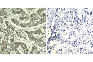 Immunohistochemical analysis of paraffin-embedded human breast carcinoma tissue using ATR (Ab-428) Antibody (E021505). (ATR antibody)