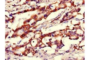 Immunohistochemistry of paraffin-embedded human gastric cancer using ABIN7146508 at dilution of 1:100 (Calnexin antibody  (AA 265-469))