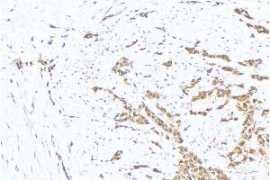 ABIN6276330 at 1/100 staining Human lung cancer tissue by IHC-P. (MTM1 antibody  (C-Term))