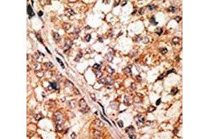 IHC analysis of FFPE human hepatocarcinoma tissue stained with the Bim antibody (BIM antibody  (AA 130-165))