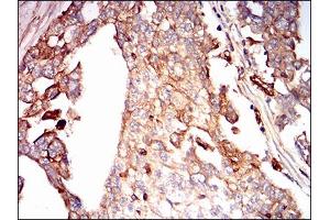 Immunohistochemical analysis of paraffin-embedded ovarian cancer tissues using SDC1 mouse mAb with DAB staining. (Syndecan 1 antibody  (AA 28-171))