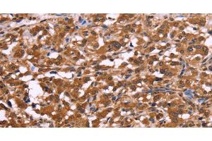 Immunohistochemistry of paraffin-embedded Human thyroid cancer using APMAP Polyclonal Antibody at dilution of 1:30 (APMAP antibody)