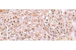 Immunohistochemistry of paraffin-embedded Human tonsil tissue using DDI2 Polyclonal Antibody at dilution of 1:75(x200) (DDI2 antibody)