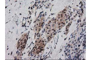 Immunohistochemical staining of paraffin-embedded Adenocarcinoma of Human breast tissue using anti-RNH1 mouse monoclonal antibody. (RNH1 antibody)