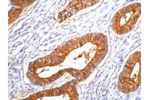 IHC staining of human colon cancer tissue, diluted at 1:200. (CEACAM5 antibody)