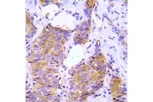 Immunohistochemical analysis of paraffin- embedded human lung adenocarcinoma tissue using Crk2 (Ab-221) Antibody (E022070). (CDK6 antibody)