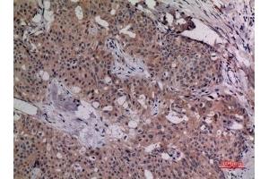 Immunohistochemical analysis of paraffin-embedded human-breast-cancer, antibody was diluted at 1:100. (IL-4 antibody  (Internal Region))