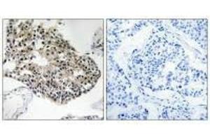 Immunohistochemistry analysis of paraffin-embedded human breast carcinoma tissue using RPS25 antibody. (RPS25 antibody)