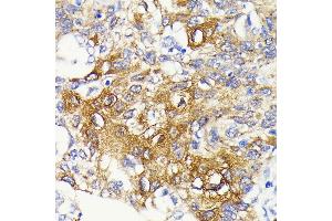 Immunohistochemistry of paraffin-embedded human lung cancer using IKKβ antibody (ABIN7267873) at dilution of 1:100 (40x lens). (IKBKB antibody)