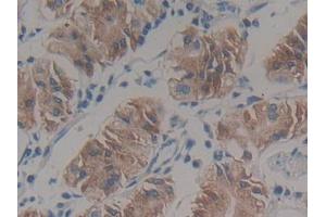 IHC-P analysis of Human Stomach cancer Tissue, with DAB staining. (HSD17B12 antibody  (AA 1-312))