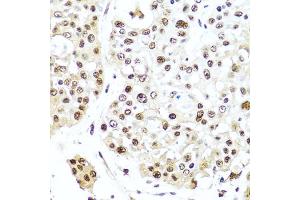 Immunohistochemistry of paraffin-embedded human colon carcinoma using TET2 antibody (ABIN6133019, ABIN6149017, ABIN6149019 and ABIN6221336) at dilution of 1:100 (40x lens). (TET2 antibody  (AA 1833-2002))