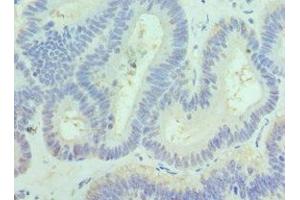 Immunohistochemistry of paraffin-embedded human colon cancer using ABIN7169126 at dilution of 1:100 (PAK1 antibody  (AA 1-240))