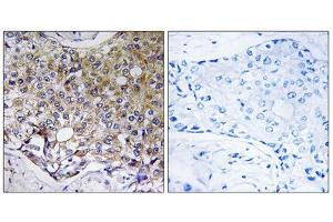 Immunohistochemistry analysis of paraffin-embedded human breast carcinoma tissue using ATG4A antibody. (ATG4A antibody  (Internal Region))