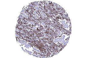 Abundant periostin positive stroma in an invasive lobular breast cancer (Periostin antibody  (AA 193-326))