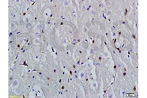 Formalin-fixed and paraffin embedded human hepatoma labeled with Anti-phospho-CDKN2A/p16-INK4a (Ser140) Polyclonal Antibody, Unconjugatedfollowed by conjugation to the secondary antibody and DAB staining (PIK3CA antibody  (pTyr317))