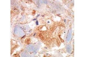 cKit antibody was used in immunohistochemistry on breast carcinoma. (KIT antibody  (AA 9-40))