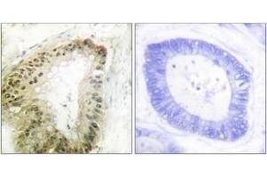 Immunohistochemistry analysis of paraffin-embedded human colon carcinoma, using LKB1 (Phospho-Ser428) Antibody. (LKB1 antibody  (pSer428))