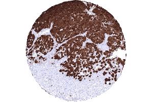 Skin Malignant melanoma with strong S100B positivity in all tumor cells (Recombinant S100A1 antibody)